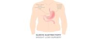 Gastric Sleeve Surgery image 4